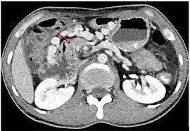Image result for Midgut Volvulus