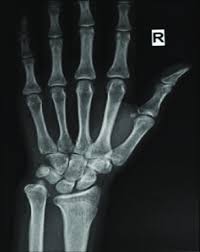 Ulnar Impaction Syndrome: A Case Series And Imaging Approach