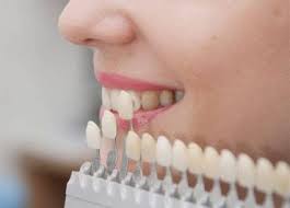 Estetik Dolgu ve Bonding - Dentram Diş Klinikleri