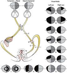 Image result for Visual Field Deficit