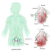 Testicular Cancer: Symptoms, Diagnosis & Treatment - Urology Care Foundation