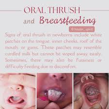 Image result for Oral thrush roof of mouth