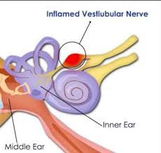 Image result for Vestibular Neuronitis