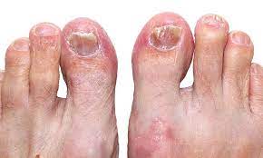 The fungi that thrives on the skin of the feet can spread to other people through direct contact with an individual who is infected or by contact. Does Toenail Fungus Ever Go Away On Its Own Jeremy Moran Dpm Podiatrist