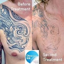 Maybe you would like to learn more about one of these? Sydney Laser Tattoo Removal