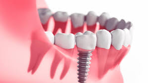 Dental Implants- Types, Procedure, Cost and Recovery: Kirkland Premier Dentistry: General Dentistry