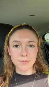 Sebaceous Filaments or Congested Pores?