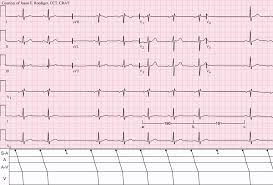 De asemenea, cele două grade mai ușoare, blocul atrioventricular. Sinoatrial Block Wikipedia