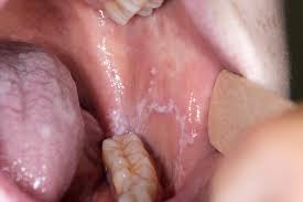 Latdr on it developed fever, diarrhoea and weight loss. Oral Ulceration Causes And Management Learning Article Pharmaceutical Journal