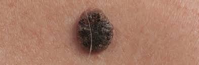 Melanomlar genelde benlere benzer, hatta bazen de benlerden kaynaklanır. Mooci Schwarzer Hautkrebs Fruherkennung Ist Lebensrettend