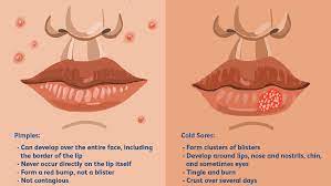Jun 05, 2020 · some people say that placing diluted apple cider vinegar on a pimple may help get rid of it quickly. Is It A Cold Sore Or Pimple