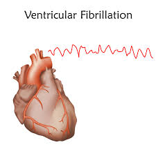 Image result for Ventricular Fibrillation