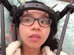 How I Lived With A Cage On My Head Keeping My Head Up High