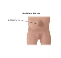 Image result for Inguinal hernia man