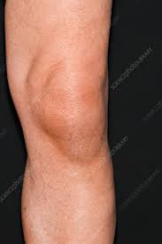 Image result for gout symptoms knee