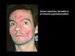 Image result for Seborrheic Dermatitis