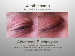 Xanthelasma, characterized by fatty, yellowish lumps around the eyes, can be removed through various different treatments. Xanthelasma Twitter Search