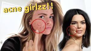 Kylie jenner says she felt so 'sad' over kendall jenner's acne struggles in high school: I Went To Kendall Jenner S Dermatologist To Save My Skin Acne Struggles Summer Mckeen Youtube