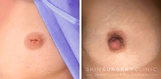 Image result for Nipple Inversion