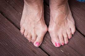 Check spelling or type a new query. What Do Meghan Markle Victoria Beckham And Oprah Winfrey All Suffer From Bunions