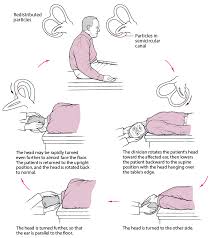 Epley repositioning maneuver for bppv  home excise. Benign Paroxysmal Positional Vertigo Ear Nose And Throat Disorders Msd Manual Consumer Version