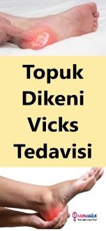 Topuk Dikeni Vicks Tedavisi Topuk Dikeni Saglik Saglik Urunleri
