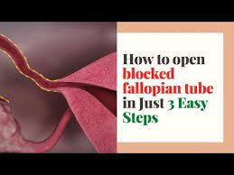 One or both ovaries are present; How To Open Blocked Fallopian Tube In Just 3 Easy Steps Fallopian Tube Fallopian Tube Blockage Open Blocked Fallopian Tubes