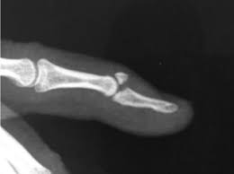 2020 popular 1 trends in beauty & health, sports & entertainment, tools, shoes with mallet finger support and 1. Osteosynthesis Of Mallet Finger Using Plate And Screws Evaluation Of 25 Patients Sciencedirect