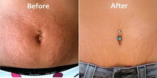 If you have a scar or stretch marks that bother you, a cosmetic treatment can help. 7 Powerful Stretch Mark Treatments Clinical Perfect Body Mate