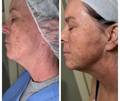 ✨ Reveal a More Sculpted You ✨ Say goodbye to stubborn fat and hello to a  firmer, more youthful look — no surgery needed. Our brand-new laser  treatment: ✔️ Lifts and tightens