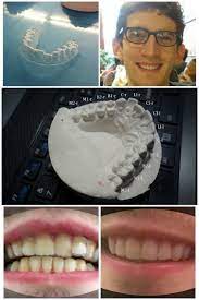 Clean Beauty Diy Invisalign Diy Braces Design Student