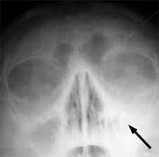 Symptoms and signs include fever, headache, coughing, shortness of breath, abdominal pain, bloody vomit. Ø§Ù„ØªÙ‡Ø§Ø¨ Ø§Ù„Ø¬ÙŠÙˆØ¨ ÙˆÙŠÙƒÙŠØ¨ÙŠØ¯ÙŠØ§