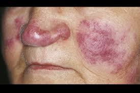 Scientists believe lupus is triggered by: ÙƒÙ„ Ø´Ù‰Ø¡ Ø¹Ù† Ù…Ø±Ø¶ Ø§Ù„Ø°Ø¦Ø¨Ø© Ø§Ù„Ø­Ù…Ø±Ø§Ø¡ Ùˆ Ø¹Ù„Ø§Ø¬Ù‡Ø§ ØªØ¯Ø§ÙˆÙˆØ§