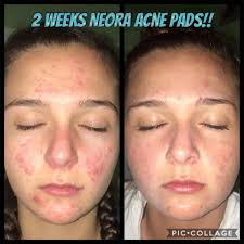 Introduction to Neora through long-term friendship