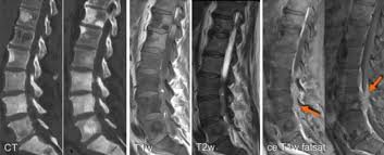 The american cancer society provides detailed information on prostate cancer and its treatment. State Of The Art Imaging For Diagnosis Of Metastatic Bone Disease Springerlink