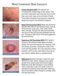 Some people are more prone to sunburn: Baby Boomers Here S How To Prevent The Most Common Cancer Of Your Generation Omnivista Health Learning