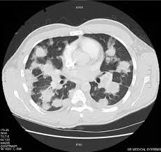 The nature (cell type) of the metastatic. Chest Computed Tomography At Diagnosis Multiple Metastases Of Download Scientific Diagram