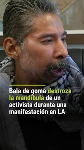 ➡️ Bala de goma destroza la mandíbula de un activista durante una  manifestación en Los Ángeles., Durante las manifestaciones en Los Ángeles,  California, en contra de los operativos migratorios, tres ...