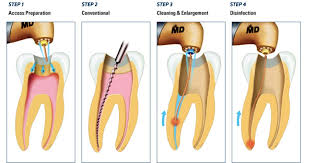 A root canal procedure seeks to remedy these symptoms by replacing the infected pulp with an inert material. Root Canal Therapy And Its Possible Complications Drjlv Com