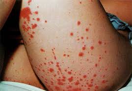 Purpura in infants and children - Dr Qaisar Ahmed