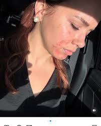 After 1 BBL/moxi laser with me 🫶🏻 #bbl #sciton #laser #moxi #pickleball