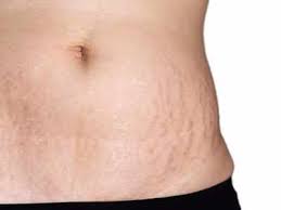More dramatic results can be achieved through the removal of excess skin and fat along with the tightening and restructuring of the underlying muscles. Stretch Marks Removal Cream Stretch Marks Problem Try These Oils Creams More Most Searched Products Times Of India