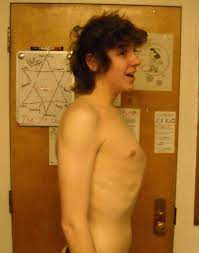 May 03, 2021 · cartilage is the tough but flexible tissue that covers the ends of your bones at a joint. Pectus Carinatum Wikipedia