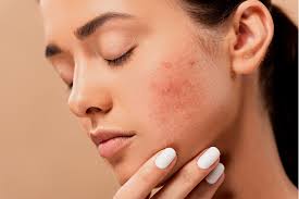 Image result for acne face