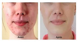 Luttez Vous Contre L Acne Ou Des Boutons Sur Votre Visage Si La Reponse Est Oui Alors Vous Pouvez Vous Debarrasser Acne Remede Acne Remede Contre Les Boutons