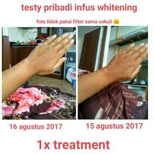 Selanjutnya untuk biaya melakukan infus whitening di natasha, biaya untuk melakukan satu kali treatment disini sekitar rp. Terjual Jasa Infus Vitamin Dan Whitening Kulit Profesional Terpercaya Kaskus