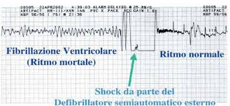 La fibrillazione ventricolare rappresenta uno dei quattro tipi di arresto cardiaco; Defibrilli Amo Il Defibrillatore Health Project Studio Facebook