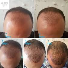 Recovery Pictures Post Transplantation Of 2500 Hairs No Noticeable Transplant Signs After 7 Days For This Gen Hair Loss Clinic Hair Transplant Treatment Rooms