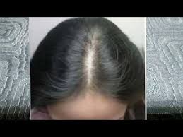 تجربتى مع المينوكسيديل فى تتقيل فراغات شعرى Minoxidil Youtube Ear Tattoo Behind Ear Tattoo Ear