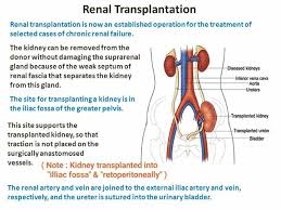 Renal Kidney Transplantation External Illiac Retroperitoneally Renal Transplant Renal Anatomy